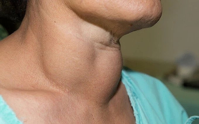 Bướu nhân tuyến giáp là gì? Biểu hiện mắc bướu nhân tuyến giáp
