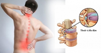 Người cao tuổi cần biết: Biểu hiện của thoát vị đĩa đệm