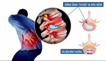 Người cao tuổi cần biết: Cách điều trị thoát vị đĩa đệm hiệu quả
