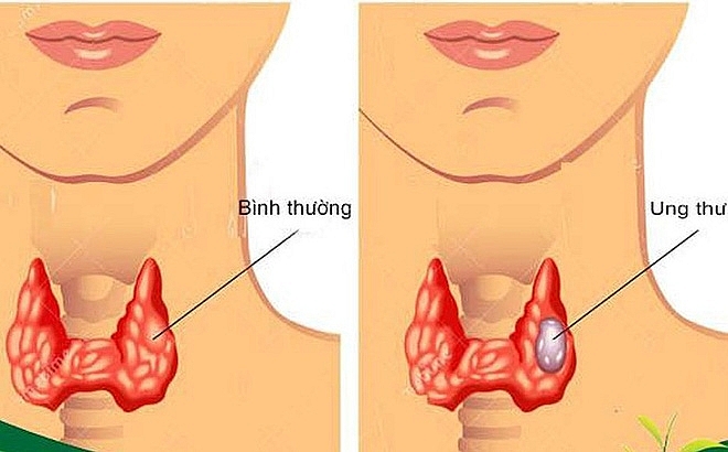 Hỗ trợ điều trị ung thư tuyến giáp bằng Nam y