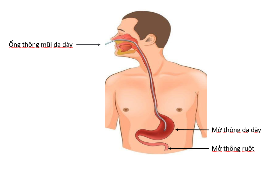 Hướng dẫn chế biến súp cho người bệnh nuôi ăn qua ống thông Hướng dẫn chế biến súp cho người bệnh nuôi ăn qua ống thông
