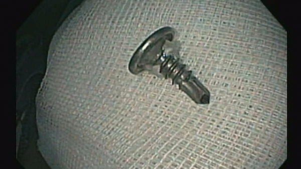 Phú Thọ: Gắp cây đinh vít nhọn trong bụng bé trai 2 tuổi