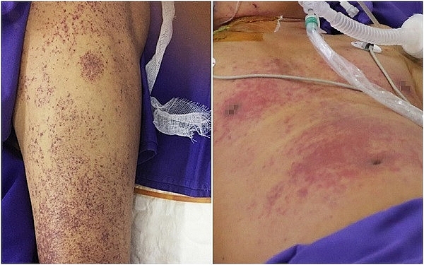 Điếc đột ngột, ù tai… cảnh giác viêm màng não do liên cầu lợn