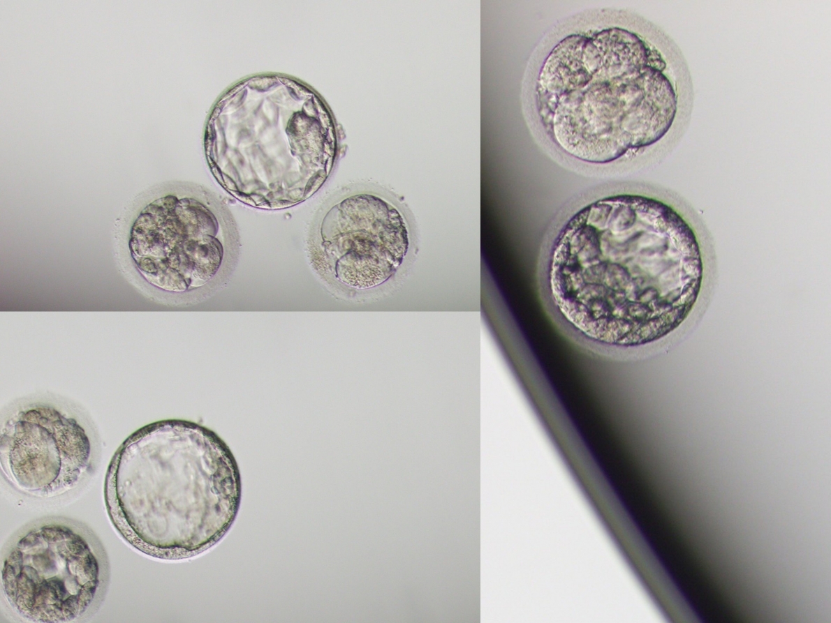 Phú Thọ: Người đàn ông không tinh trùng vẫn có 2 con sinh đôi