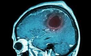 8 biểu hiện của bệnh u não cần cảnh giác