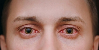 Bộ Y tế khuyến cáo 5 biện pháp phòng bệnh đau mắt đỏ
