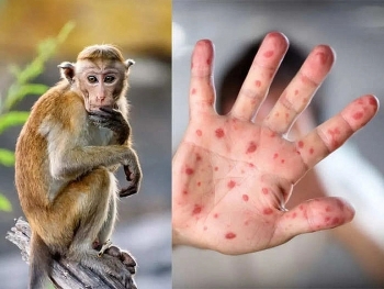 Yêu cầu tăng cường giám sát phòng chống bệnh đậu mùa khỉ