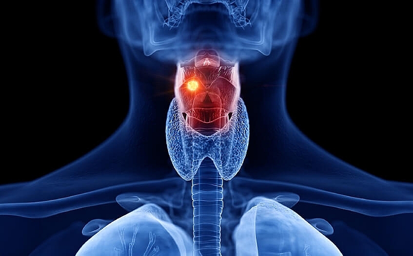 Dấu hiệu, nguyên nhân và điều trị ung thư thanh quản