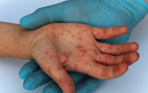 Ghi nhận bệnh nhân đậu mùa khỉ đầu tiên tử vong