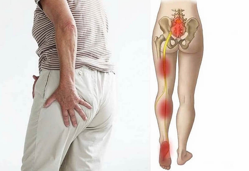 Đau thần kinh tọa có nên đi bộ không?