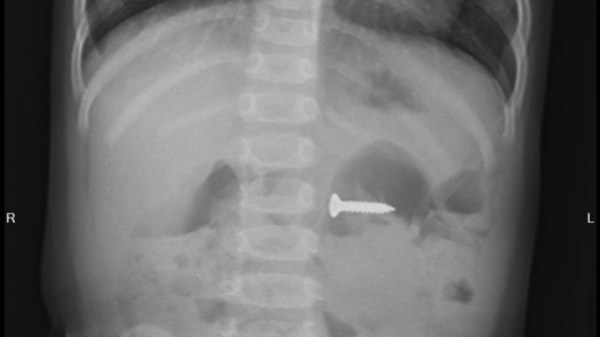 Phú Thọ: Gắp đinh vít sắc nhọn trong bụng bé gái 2 tuổi