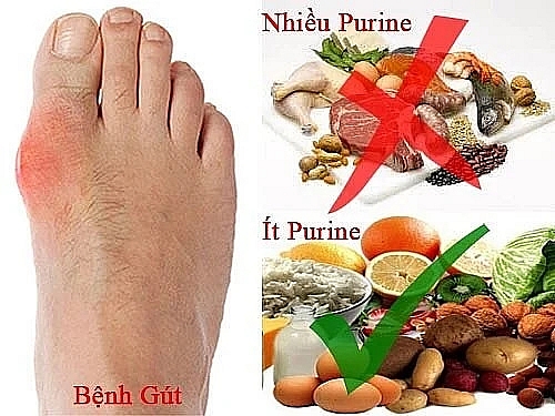 Món ăn, thức uống cải thiện bệnh gout