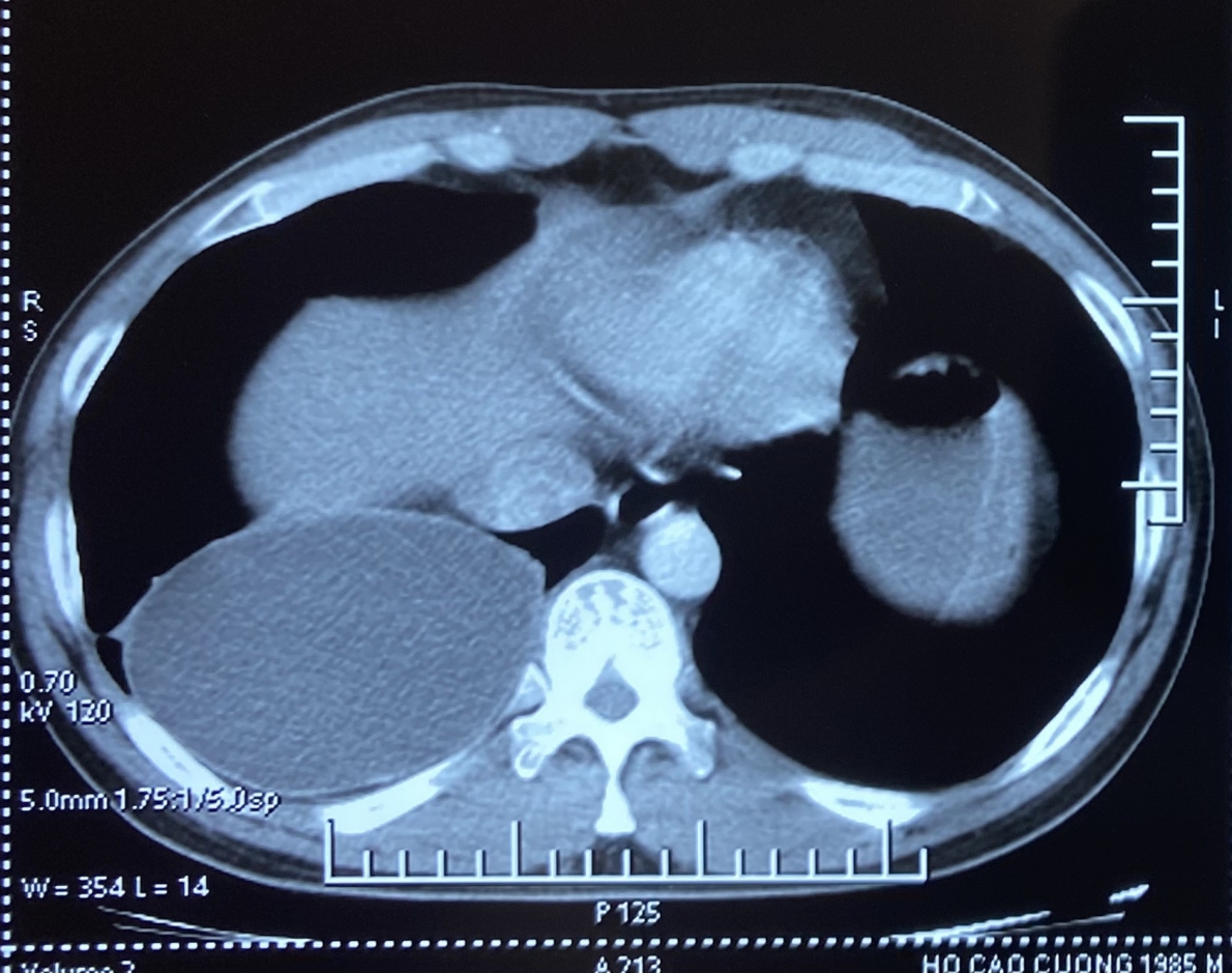 Bệnh viện 108 phẫu thuật thành công cho bệnh nhân nhiễm ấu trùng sán dây chó ký sinh tại phổi