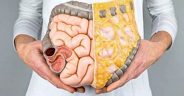 Tích tụ nhiều “chất béo nội tạng” là nguyên nhân gây loãng xương