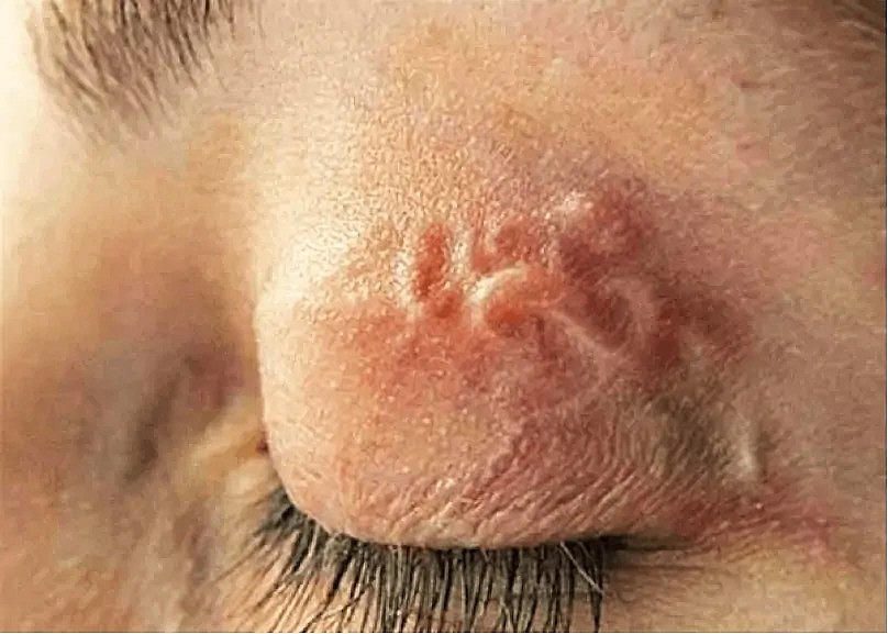 Dấu hiệu nhiễm kí sinh trùng sau khi ăn gỏi sống