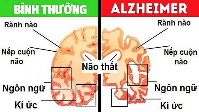 Cách ngăn ngừa bệnh Alzheimer tiến triển