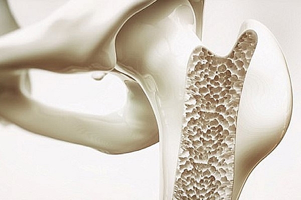 Dấu hiệu loãng xương ở người cao tuổi