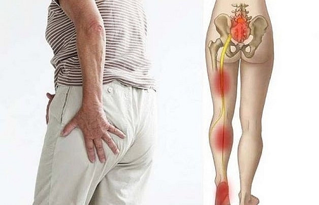 Thói quen cần tránh khiến đau thần kinh tọa thêm trầm trọng
