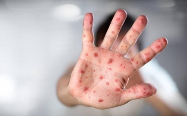 Hà Nội: Khẩn trương phòng chống dịch tay chân miệng