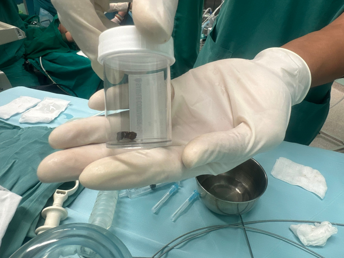 TP. Hồ Chí Minh: Lấy dị vật trong đường thở cho bé trai 8 tháng tuổi