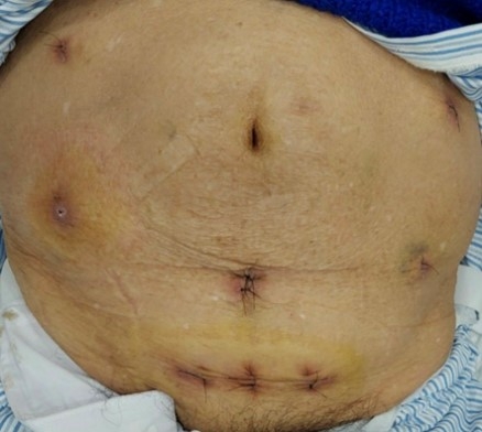 Phẫu thuật nội soi cho NCT mắc ung thư đại tràng