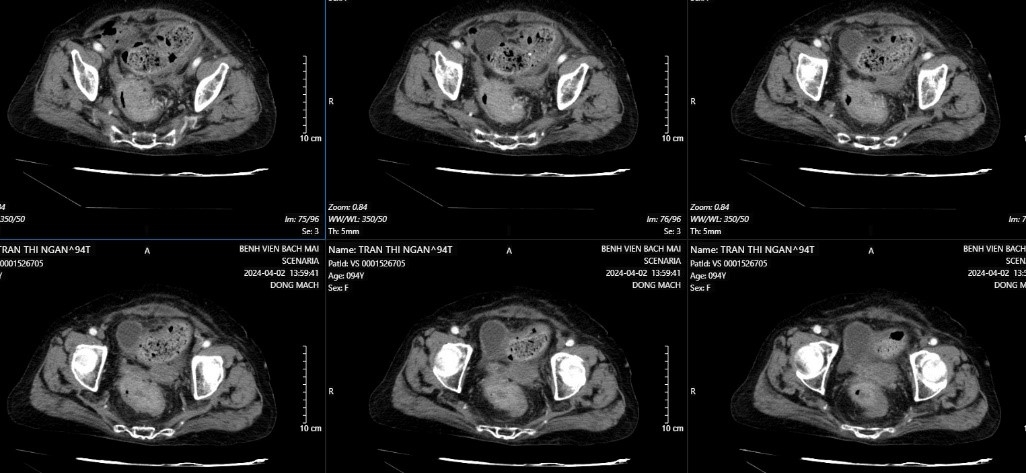 Phẫu thuật nội soi cho NCT mắc ung thư đại tràng