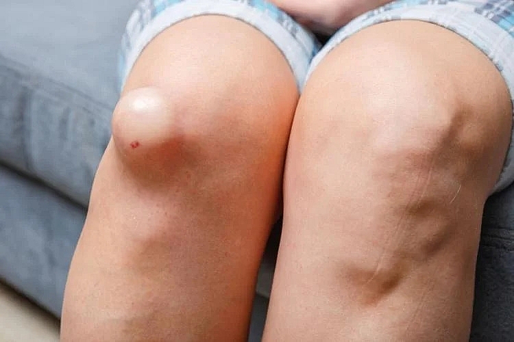 Cách nhận biết và điều trị nang hoạt dịch