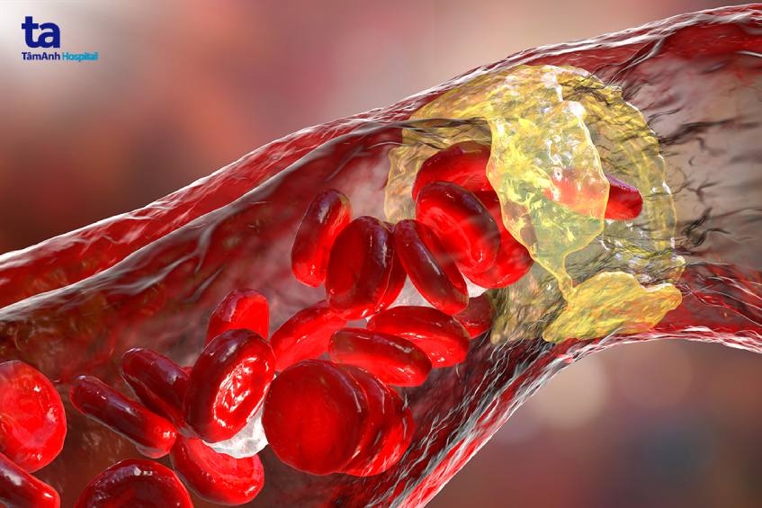 Mỗi năm có khoảng 200.000 người tử vong vì bệnh tim mạch