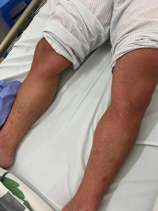 Cảnh báo nhiều ca sốt xuất huyết với những biến chứng nguy hiểm