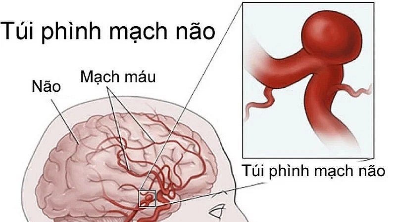 Sự nguy hiểm của vỡ phình mạch não