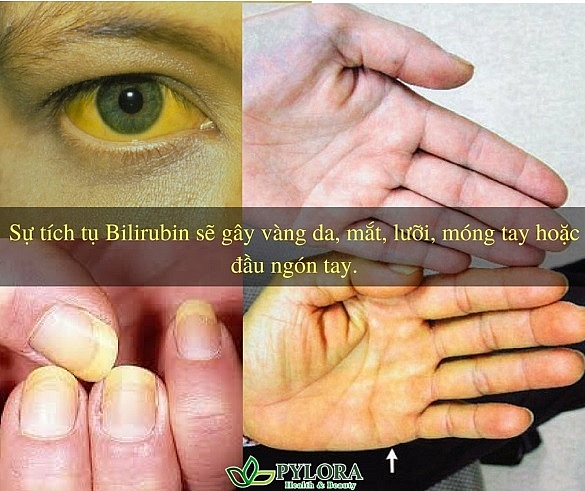 Dấu hiệu và nguyên nhân bệnh vàng da ở người lớn