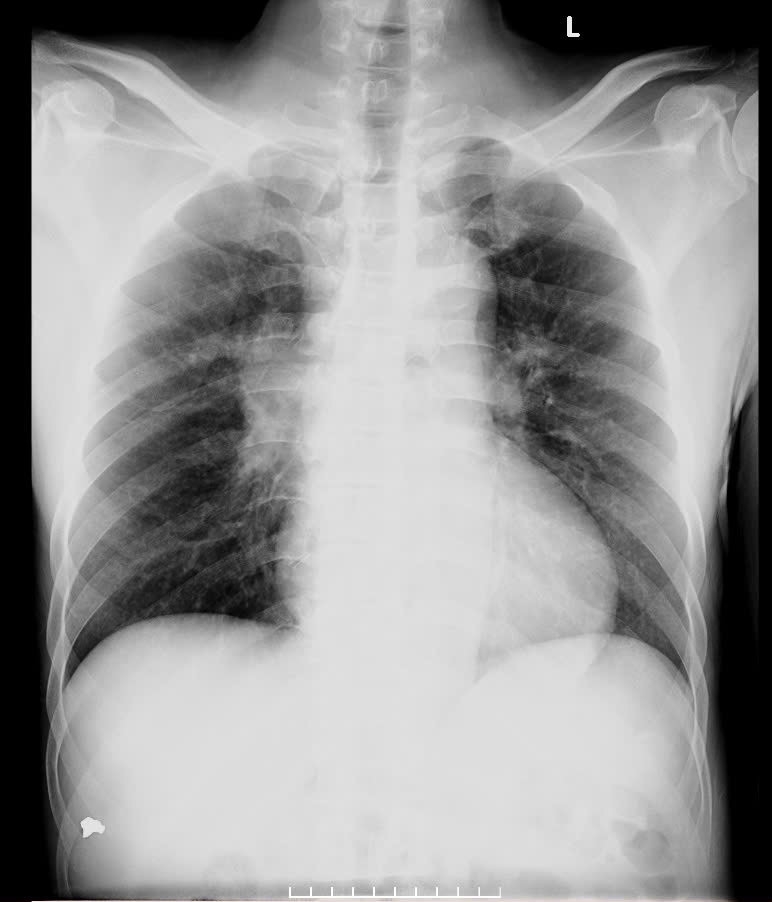 Bản án cuối cùng của việc nghiện thuốc lá trên 30 năm