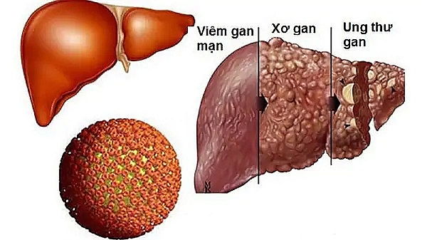 Cách nhận biết các giai đoạn của bệnh xơ gan