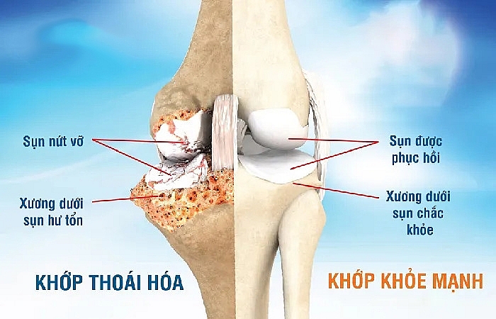 Dược thiện phòng chống thoái hóa khớp gối