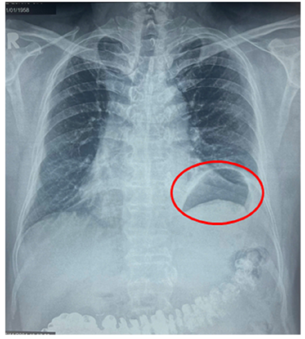 Phẫu thuật robot tạo hình cơ hoành trái cho người bệnh khó thở do nhão hoành