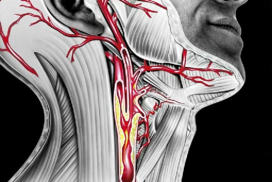 Hẹp động mạch cảnh