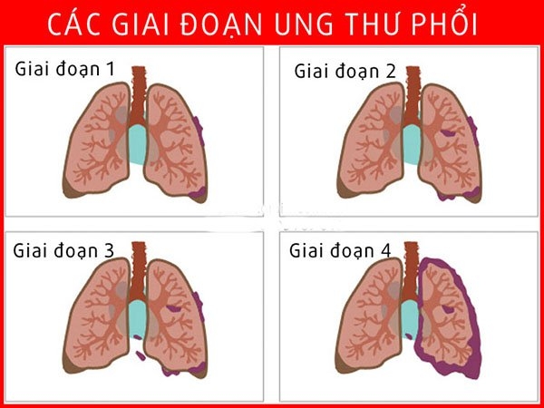 90% ung thư phổi xuất phát từ thói quen hút thuốc lá