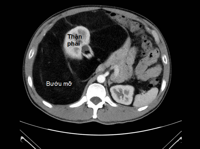 Phẫu thuật lấy bướu mỡ khổng lồ nặng 8 kg trong bụng bệnh nhân