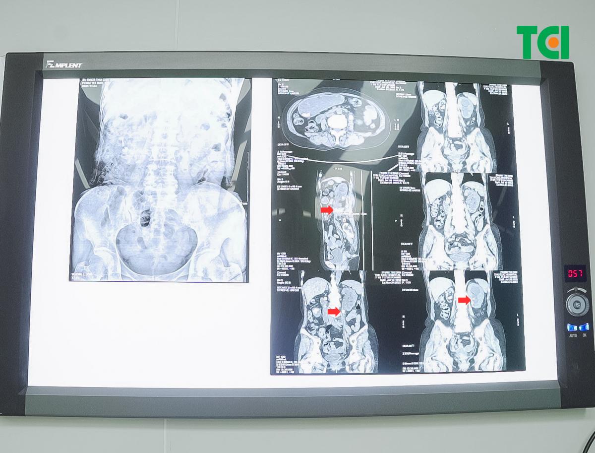 Hình ảnh sỏi niệu quản, sỏi thận trái bệnh nhân P.T.Đ (Ảnh: TCI).