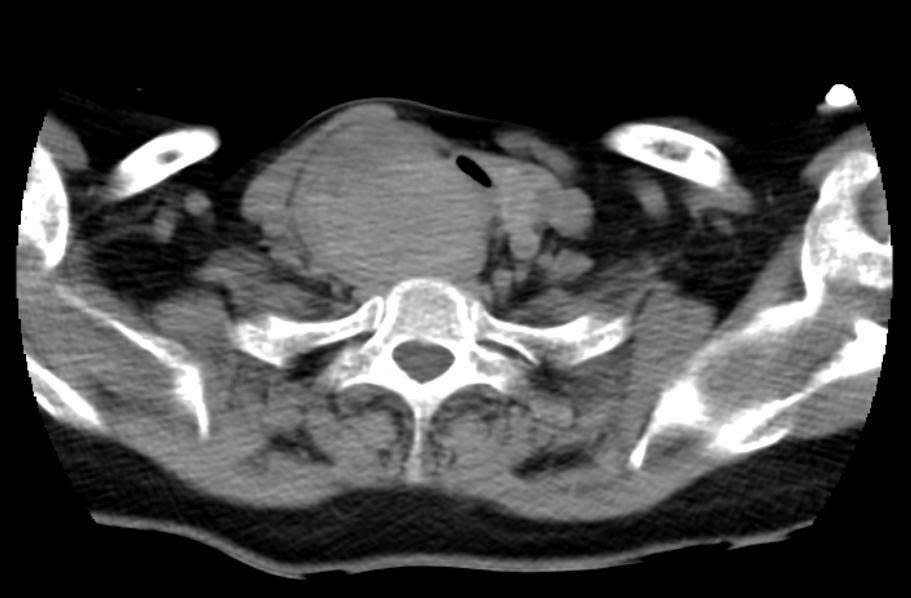 Khối u chèn ép khí quản và thực quản