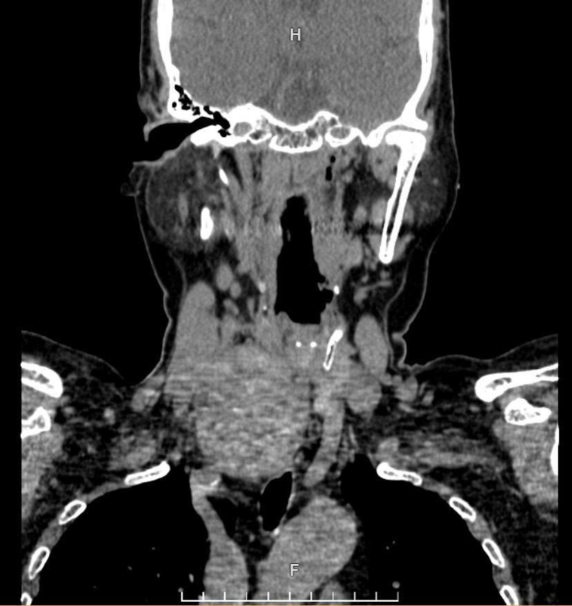 Cứu sống bệnh nhân suy tim với khối u hiếm gặp