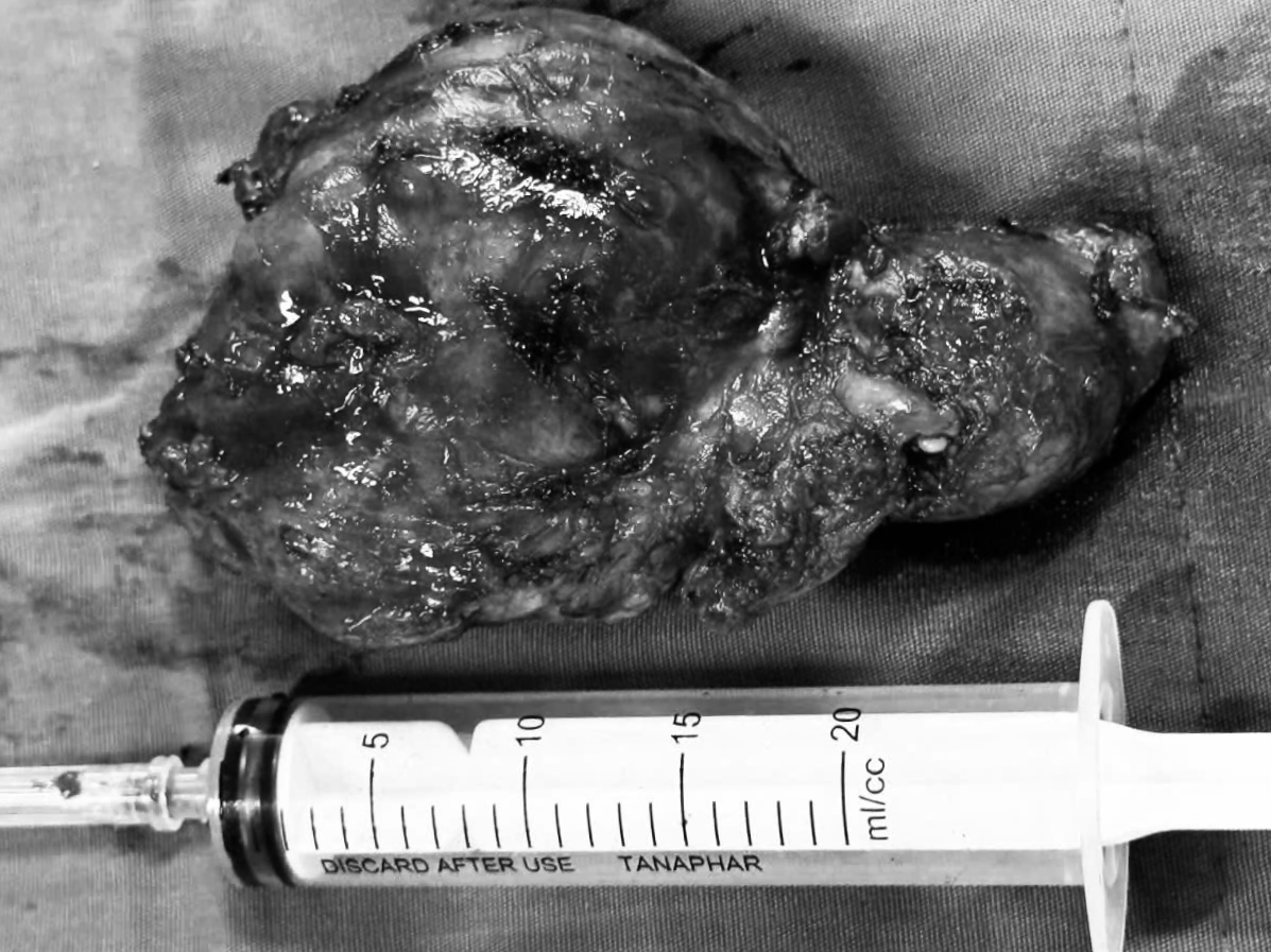 Cụ bà 93 tuổi được phẫu thuật cắt bỏ bướu giáp khổng lồ