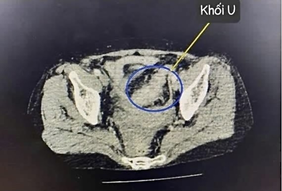 Cứu sống bệnh nhân 64 tuổi nguy kịch nhờ phẫu thuật nội soi cấp cứu
