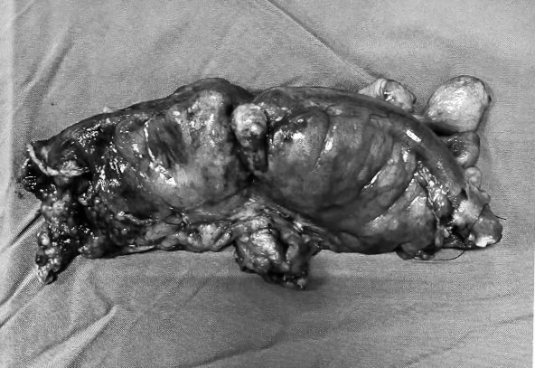 Cứu sống bệnh nhân 64 tuổi nguy kịch nhờ phẫu thuật nội soi cấp cứu