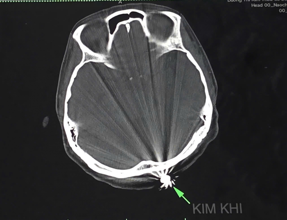 TP. Cần Thơ cứu kịp thời một trường hợp hy hữu