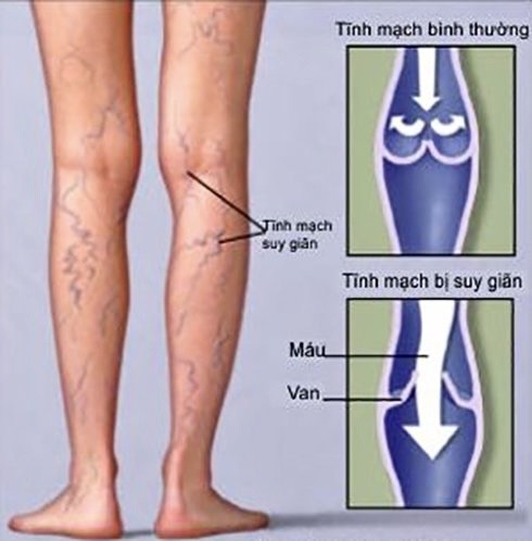 Hình ảnh về bệnh suy giãn tĩnh mạch chi dưới 