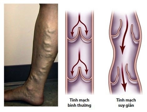 Bệnh suy giãn tĩnh mạch chi dưới ảnh hưởng đến sức khỏe, thẩm mỹ