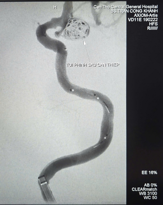 Hình ảnh túi phình mạch não sau khi can thiệp