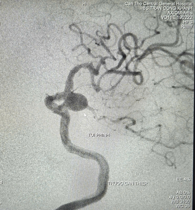 Hình ảnh túi phình mạch não trước khi can thiệp