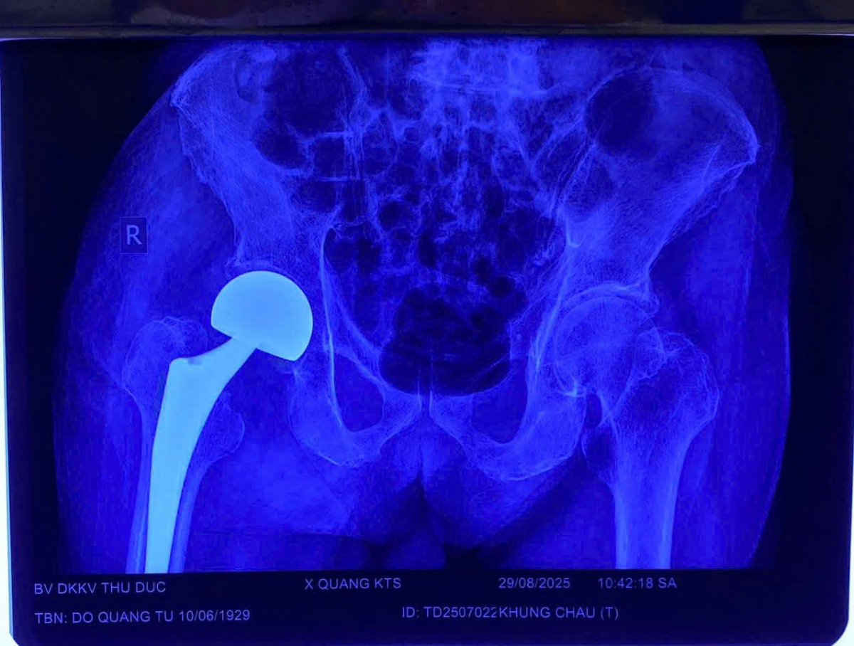Bác sĩ phẫu thuật thay khớp háng cho bệnh nhân cao tuổi tại TP.HCM